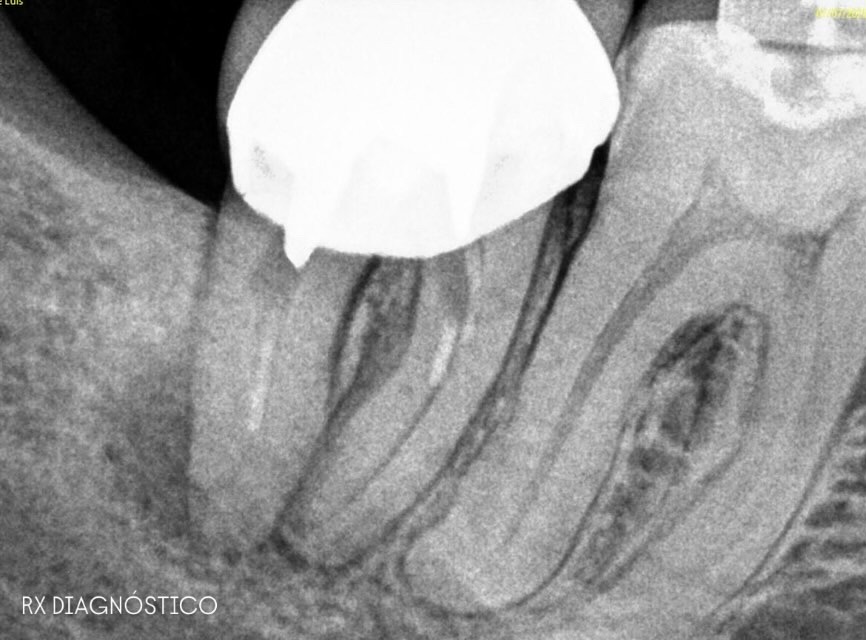 Radiografía antes de un retratamiento de endodoncia